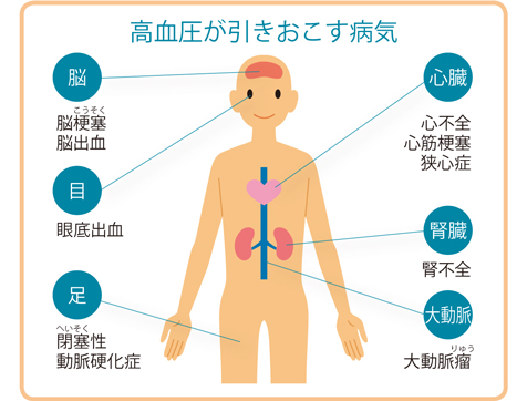 血圧高めは命にかかわる病気の引き金に