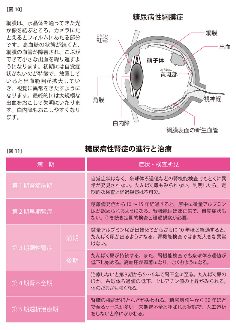 糖尿病が恐ろしいのは合併症があるから。失明したり、人工透析のリスクも